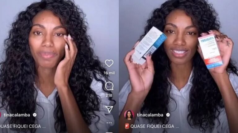 Tina, ex-participante do BBB 23, revelou em live no Instagram que quase ficou cega após usar pomada para cabelo Crédito: Reprodução/Instagram Leia mais em: https://www.opovo.com.br/noticias/economia/2023/06/20/pomada-capilar-anvisa-publica-nova-interdicao-cautelar-contra-produtos.html ©2022 Todos os direitos são reservados ao Portal O POVO, conforme a Lei nº 9.610/98. A publicação, redistribuição, transmissão e reescrita sem autorização prévia são proibida