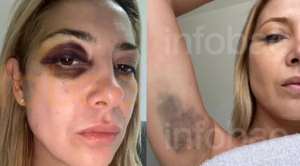 Fabiola Yañez, ex-primeira-dama da Argentina, aparece com hematomas pelo corpo após supostas agressões de Alberto Fernández (Foto: Infobae)